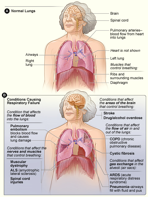File:Respiratory failure.jpg