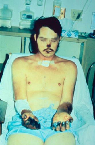 File:Acral necrosis due to bubonic plague.jpg