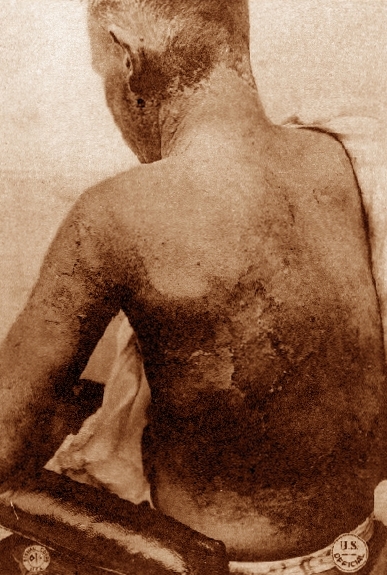 File:MustardGasBurns2.JPG
