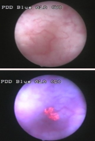 File:Blue light cystoscopy CIS.jpg