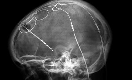 File:Deep Brain Stimulation.jpg