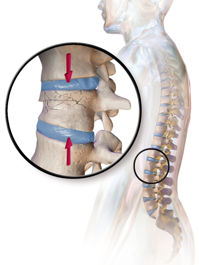 File:Blausen 0250 CompressionFracture Vertebrae.png