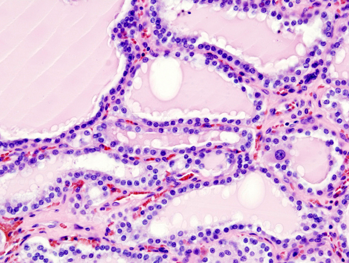File:Hyperthyroidism (2).jpg