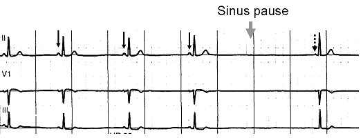 File:Sinus pause.PNG