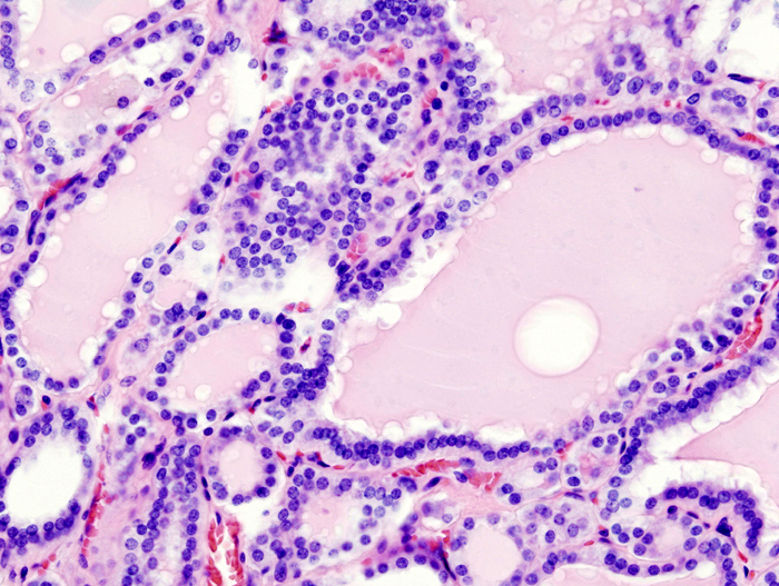 File:Hyperthyroidism (1).jpg
