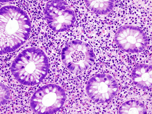 File:Ulcerative colitis (2) active.jpg