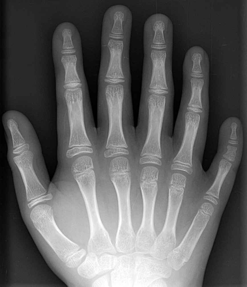 File:Polydactyly 01 Rhand AP.jpg