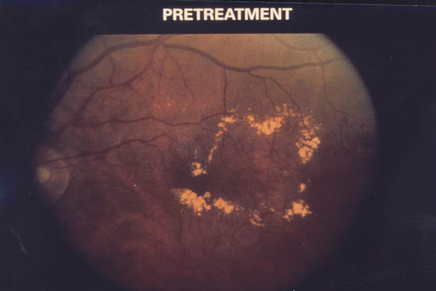 File:Fundus Diabetic macular edema EDA04.JPG
