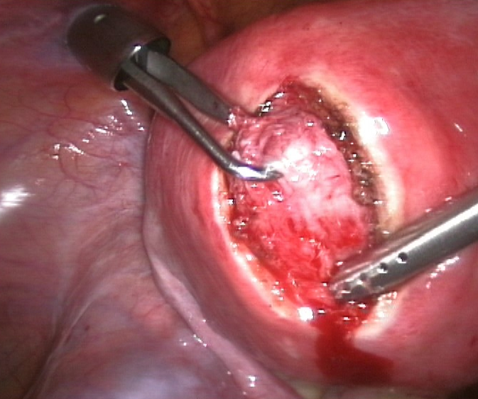 File:Myomenukleation.jpg