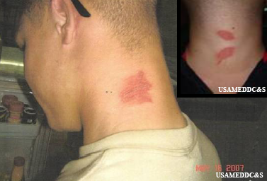File:PaederusDermatitis.png