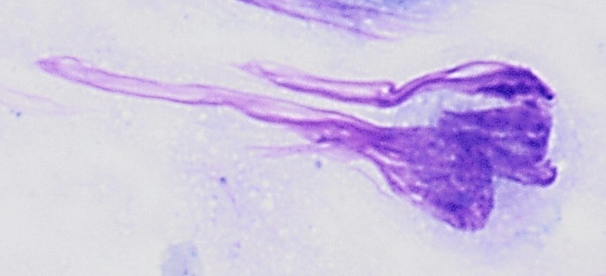 File:Pap smear of a monocyte with nuclear smearing artifact.jpg