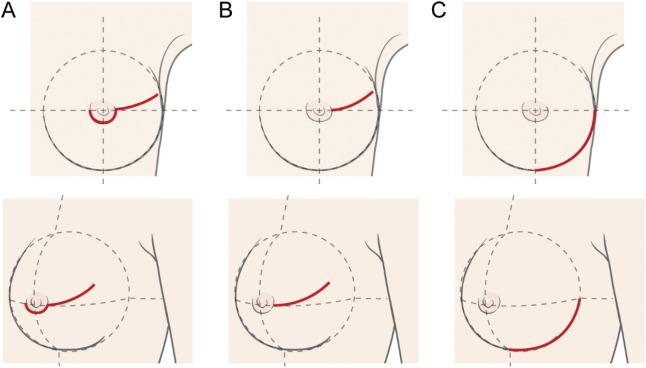 File:Incision of breast.jpg