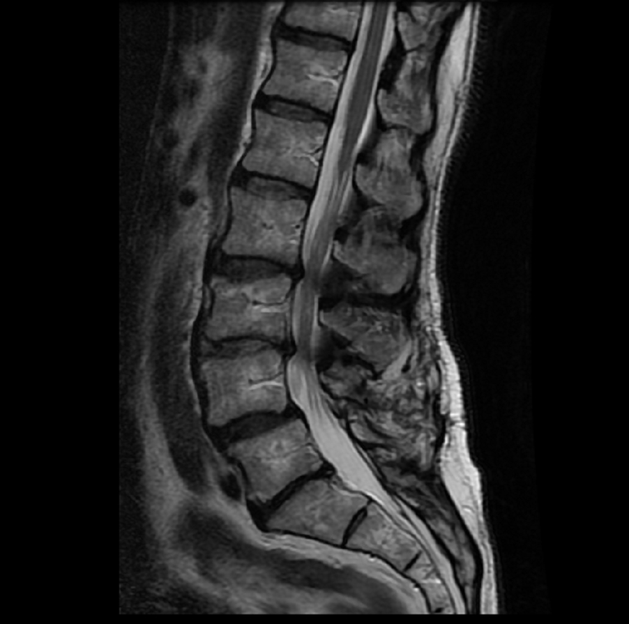 File:SAG.-T2-FRFSE-L-SPINE.jpg