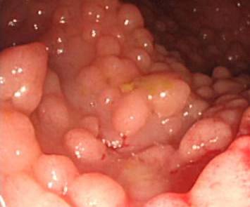 File:Polyposis.jpg