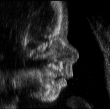 File:Fetal face profile.jpg