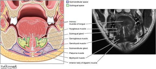 File:Submandibular and sublingual space.jpg