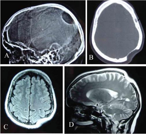 File:Gorham's disease.jpg