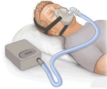 File:CPAP.png