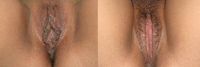 File:Wiki clitoral hood reduction before & After.JPG
