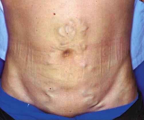 File:Caput medusae.jpg