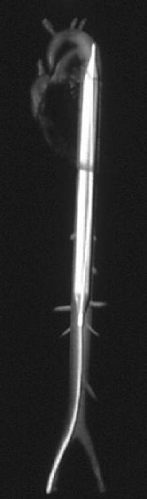 File:Intra-aortic balloon pump.jpg