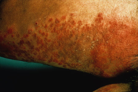 File:Derm-57.jpg