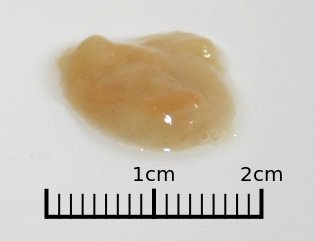 File:Phlegm.jpg