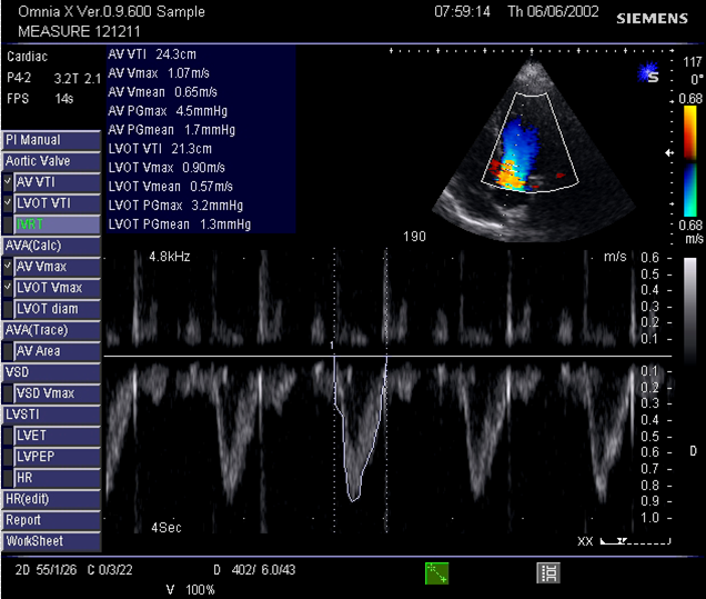 File:VTI LVOT.png