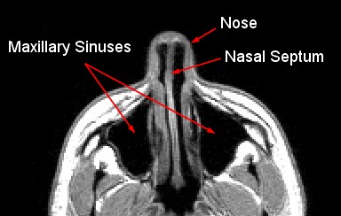 File:Maxillary sinus MRI.jpg