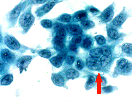 File:Cytology corneal herpes multinucleated cell.jpeg
