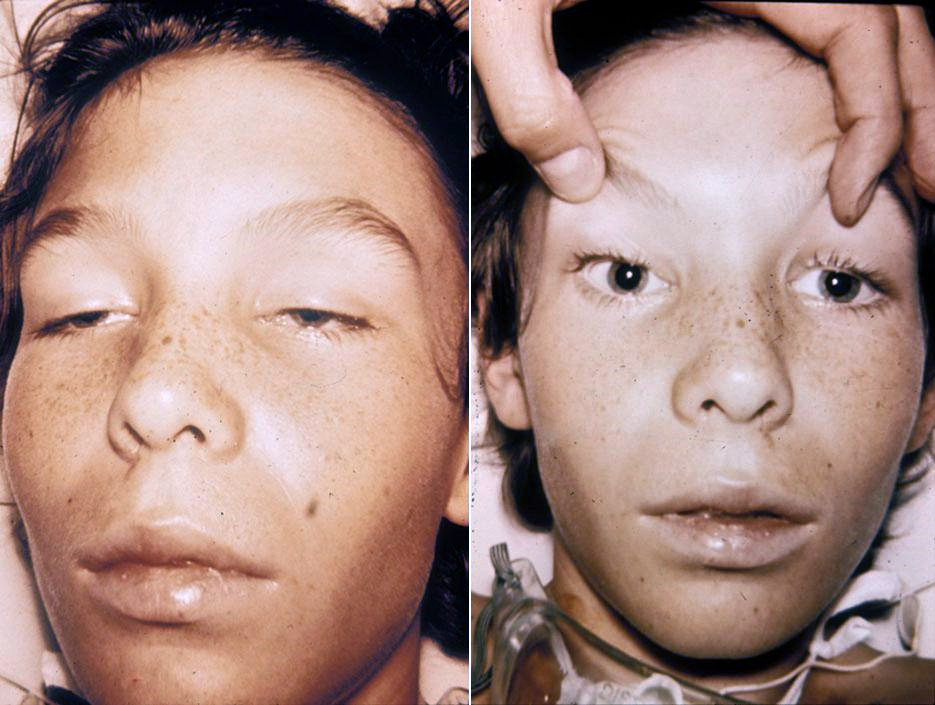 File:Botulism1and2.JPG