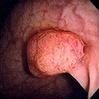File:Polyp-2.jpeg