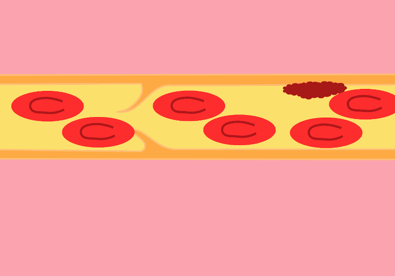 File:Thrombosis formation.gif