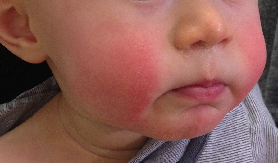 File:Slapped cheek Erythema Infectiosum.png