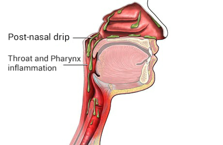 File:Post nasal drip en.png