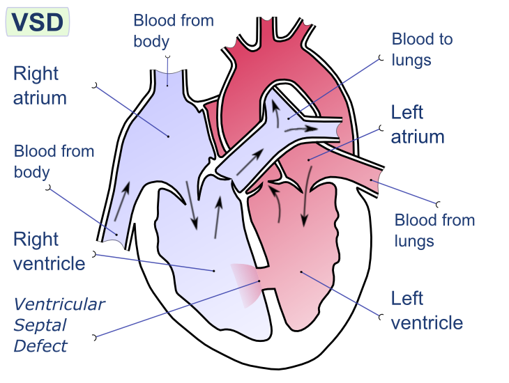 File:Ventricular septal defect-en.png