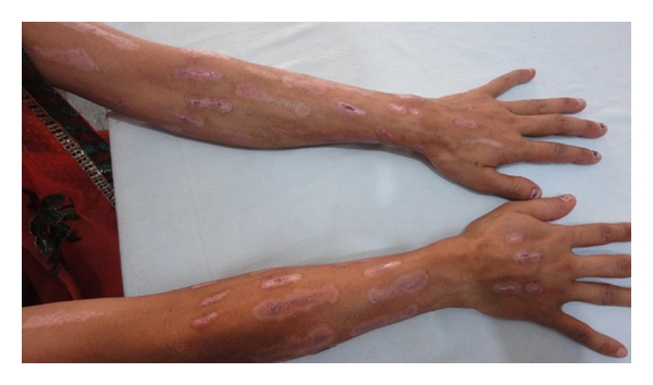 File:Factitious dermatitis.jpg