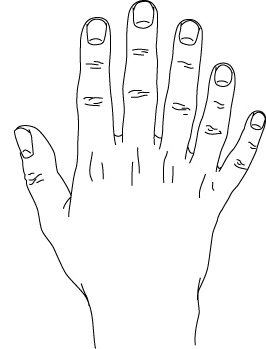 File:Polydactyly postaxial.gif