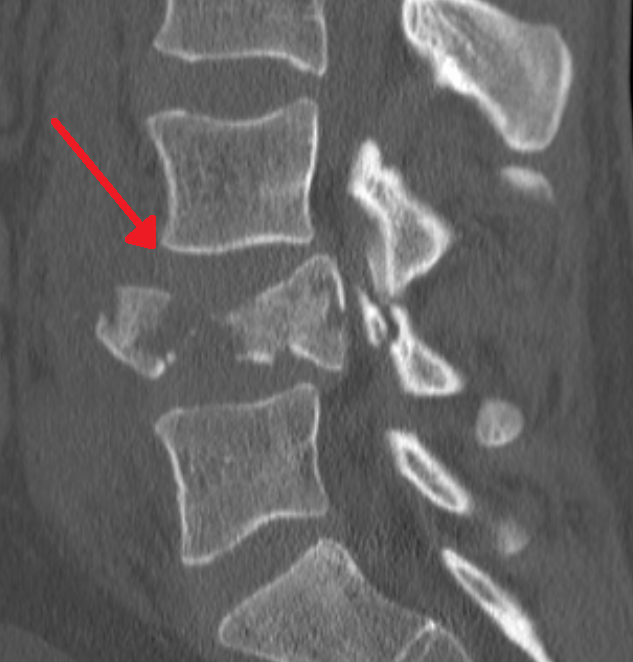 File:BurstSaL4LCT.png