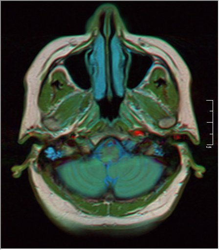 File:Brain MRI 0106 17.jpg