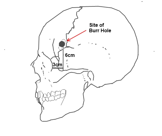 File:Lobotomy 1.jpg
