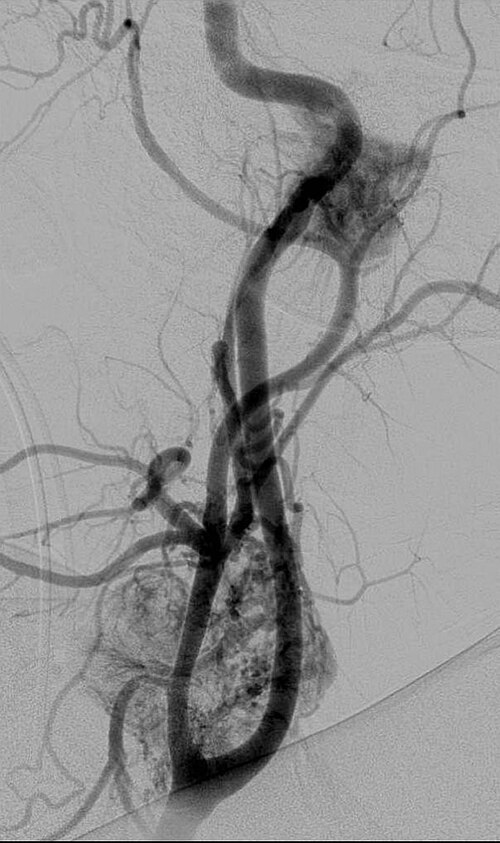 File:Carotid Body Tumor.jpg