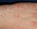 Scabies
