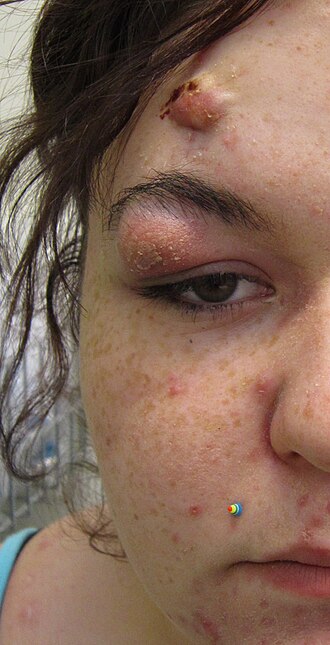 File:Cysticacne-cropped.jpg