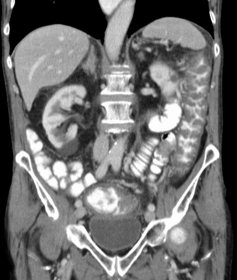 File:Pseudomembranoese Colitis coronar.jpg