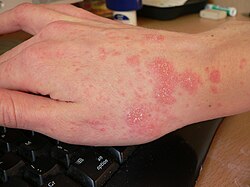 Day 8 (treatment begins)