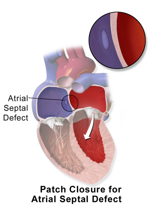 File:Blausen 0070 AtrialSeptalDefect PatchClosure.png