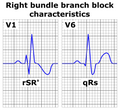 Leads V1 and V6 in RBBB