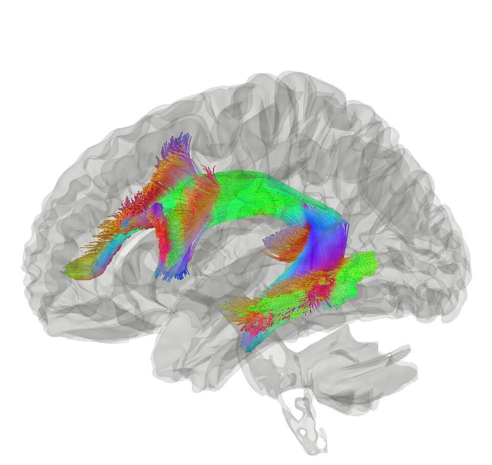 File:Arcuate Fasciculus.jpg