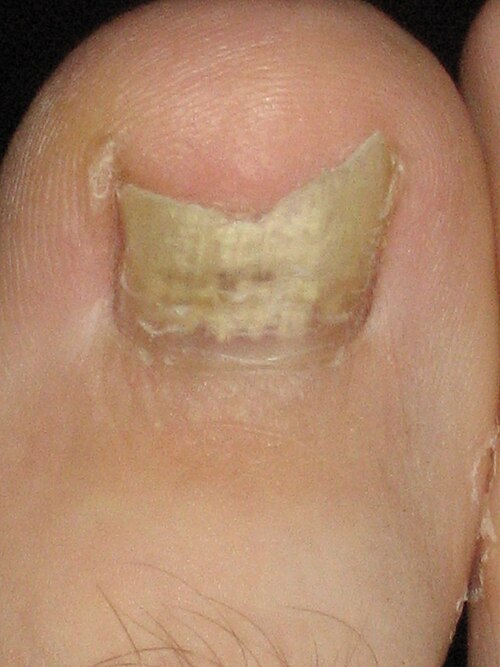File:Toefungus.jpg